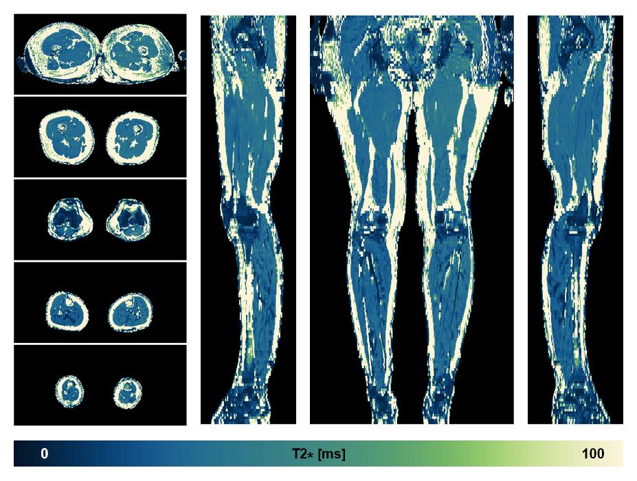 The T2 star relaxation time of the lower extremity obtained from the dixon reconstruction for muscle water fat quantification.